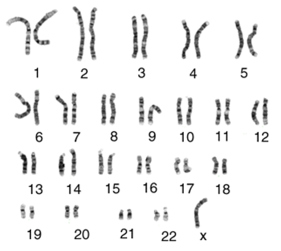 Síndrome de Turner (ausencia de un cromosoma X, es decir X0)