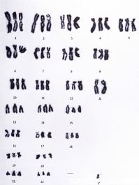 Triploidy. Cariotipo de un triploide (3 genomios)