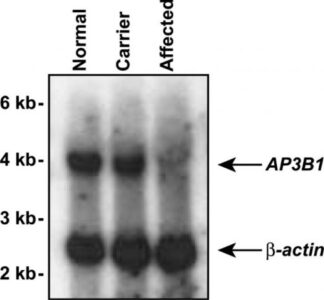 Neutropenia Benson et al 2004